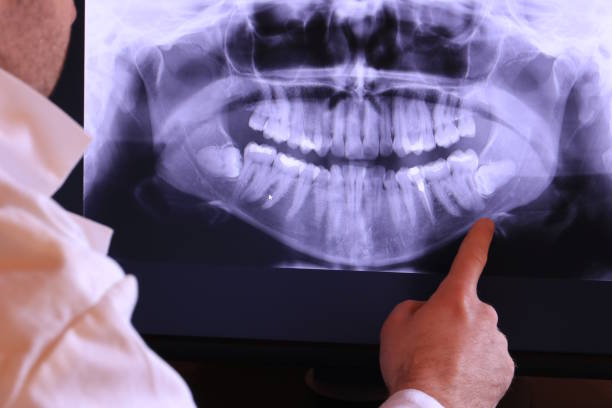 Best Emergency Wisdom Teeth Removal in Rome, GA